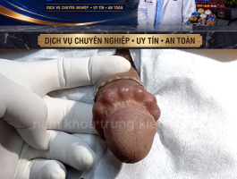 COMBO CẮT BAO QUY ĐẦU & CẤY CHUỖI SILICON CAO CẤP