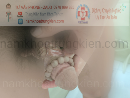 Hoàn thiện Chuỗi vòng Bạc Đạn Silicon đạt độ thẩm mỹ cao cho sự hài lòng KH 