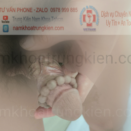 Hoàn thiện Chuỗi vòng Bạc Đạn Silicon đạt độ thẩm mỹ cao cho sự hài lòng KH 