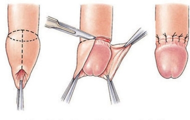 Cắt bao quy đầu: Giải pháp cho sức khỏe nam giới tại Nam Khoa Trung Kiên