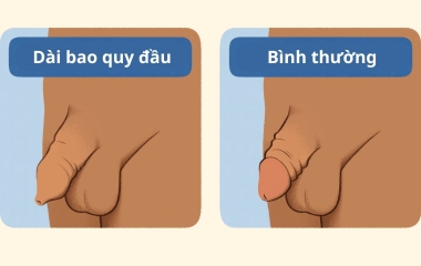 Cắt Bao Quy Đầu: An Toàn Hiệu Quả tại Phòng Khám Nam Khoa Trung Kiên
