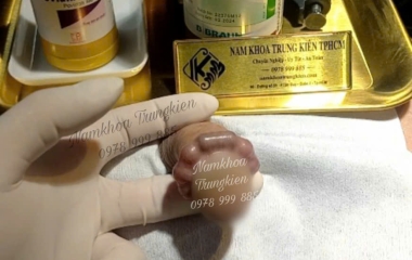 Độ Tuổi Của Đàn Ông Thích Hợp Để Cấy Bi – Hiểu Đúng, Làm Đúng