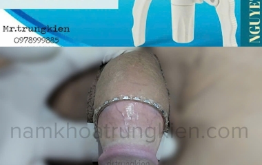 TRUNG TÂM CẮT BAO QUY ĐẦU UY TÍN 2025: So Sánh Phương Pháp & Lựa Chọn