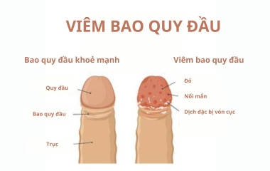 Viêm Bao Quy Đầu: Nguyên Nhân, Triệu Chứng và Cách Điều Trị Hiệu Quả