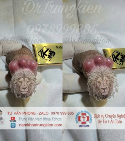 BỘ 3 VIÊN CHO ĐIỂM G 
