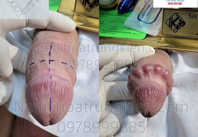 Tìm Kiếm Trung Tâm Cắt Bao Quy Đầu Uy Tín Tại Hồ Chí Minh