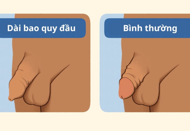 Cắt Bao Quy Đầu: An Toàn Hiệu Quả tại Phòng Khám Nam Khoa Trung Kiên