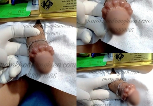 Xu Hướng Cấy Bi Dương Vật Cho Nam Giới Hiện Nay