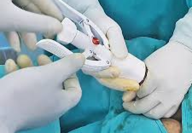  Phẫu thuật cắt bao quy đầu: Giải pháp toàn diện cho sức khỏe của nam giới