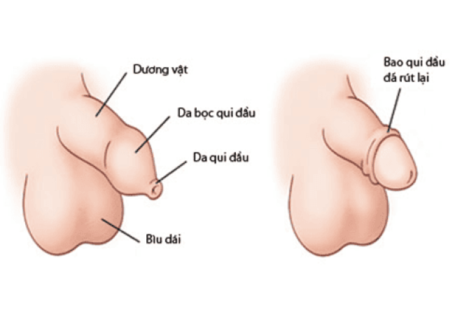 Khám phá lợi ích của cắt bao quy đầu: Giải pháp cho sức khỏe nam giới