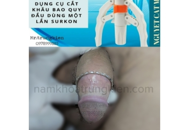 Cắt Bao Quy Đầu Khi Nào Lành?