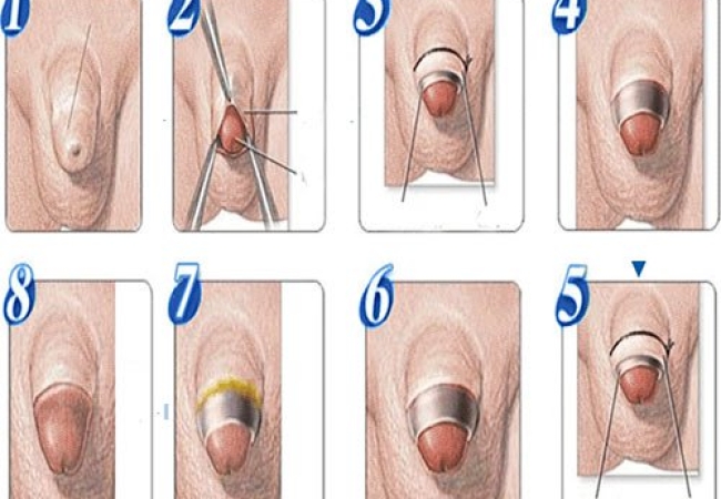 Quy Trình Cắt Bao Quy Đầu An Toàn, Thẩm Mỹ Tại Nam Khoa Trung Kiên