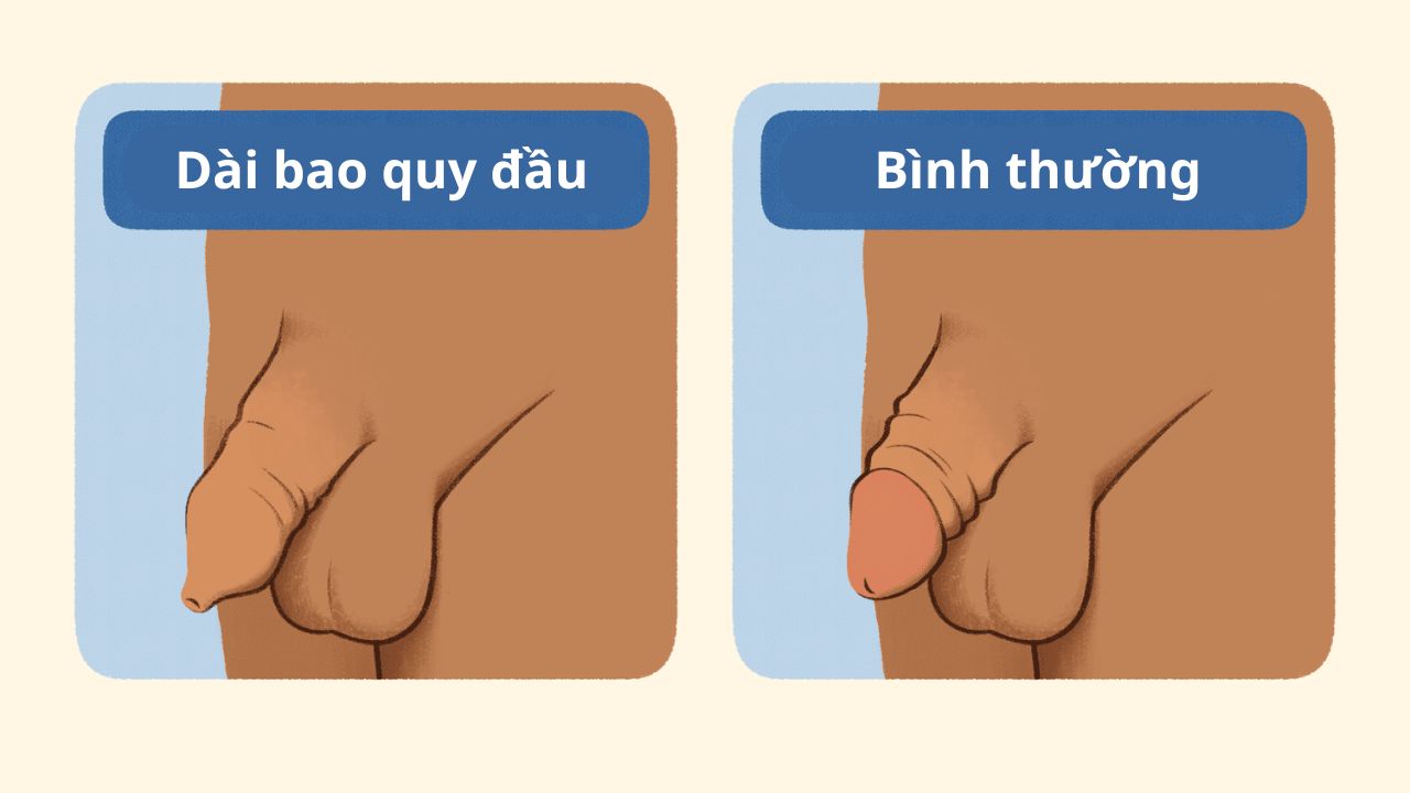 Cắt bao quy đầu
