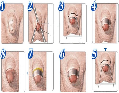 quy trình cắt bao quy đầu