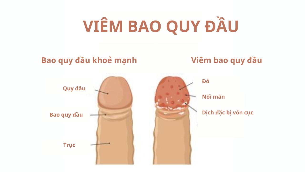 Viêm bao quy đầu