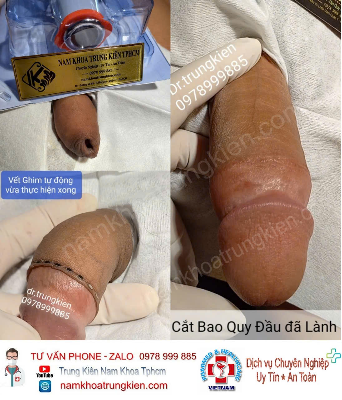 TRUNG TÂM CẮT BAO QUY ĐẦU UY TÍN