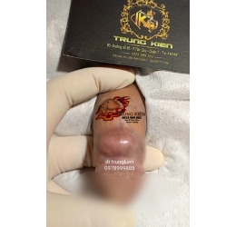 Cấy Bi Viên Ovan Êm ái Kích thích bạn Tình 