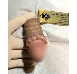 Combo Cắt Bao Quy Đầu & Cấy Chuỗi Bi Bạc Đạn 