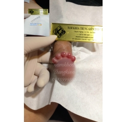 Cấy Bi Silicon Bạch Kim Cao Cấp Tphcm