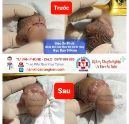 Sửa chữa từ bộ bi cũ thành bộ chuỗi vòng Bạc Đạn 