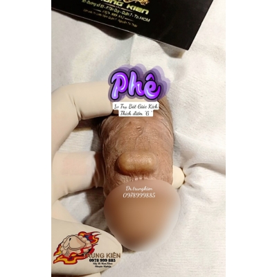 Cấy Bi Găm Bi Cậu Nhỏ 1v Bát Giác Điểm G - NAM KHOA TRUNG KIÊN quận 7 Tphcm 