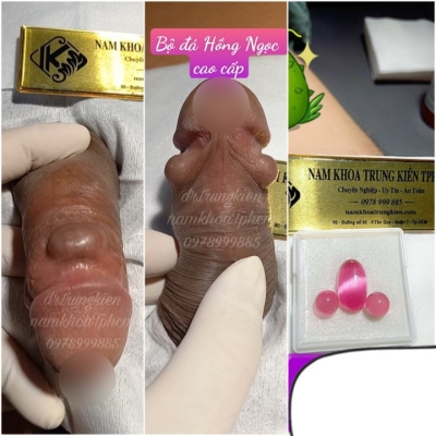 Bộ 3v Bi Đá Nam Khoa cao cấp đá Hồng Ngọc 