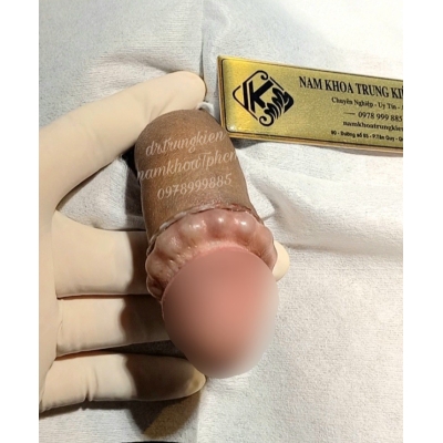 Combo Cắt Bao Quy Đầu & Cấy Chuỗi Bi Bạc Đạn 