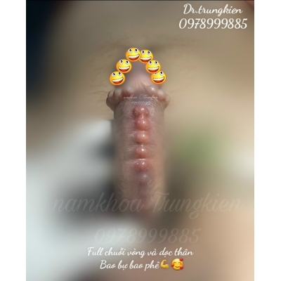 Cấy bi Chuỗi dọc thân Cậu Nhỏ 