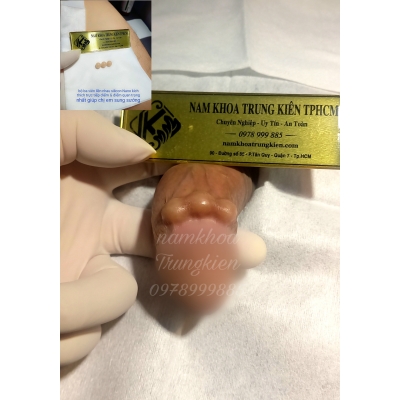 Cấy Bi Sài Gòn Bộ Bi 3v Điểm G 
