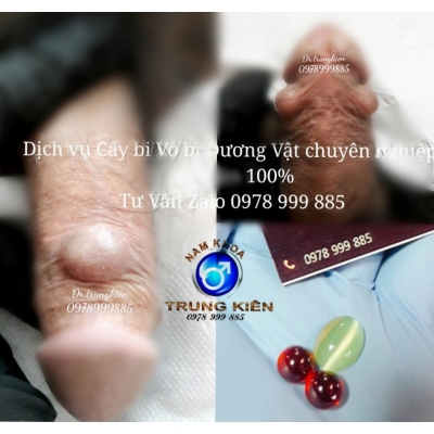 Cấy bi bộ 3 đá Cao Cấp 