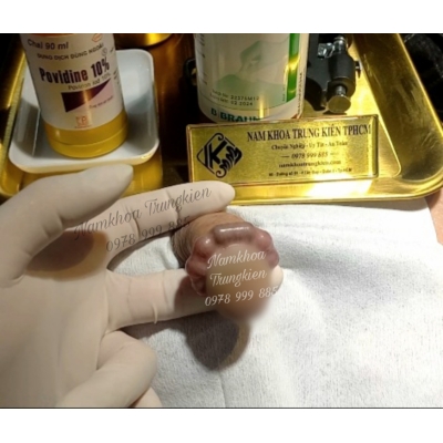 Cấy Bi Bộ Vòng Bi Bạc Đạn cho 1 viên Điểm G đặc biệt