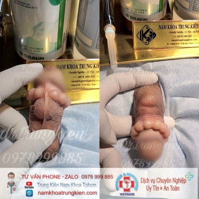 Cấy Bi giúp Đôn To cậu nhỏ hiệu quả - Cấy Bi an toàn Hcm