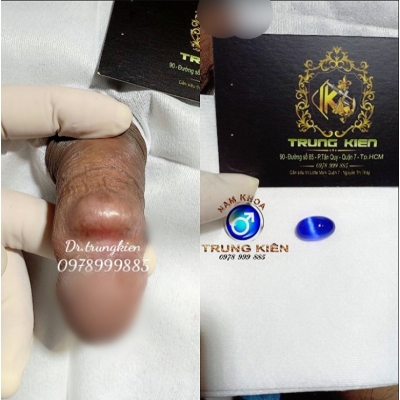Viên Bi đá Ovan Cao Cấp .Cấy Bi Găm Bi Quận 7