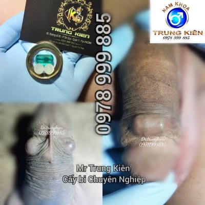 Cấy bi bộ 3 viên đá Thạch Anh thiên nhiên 