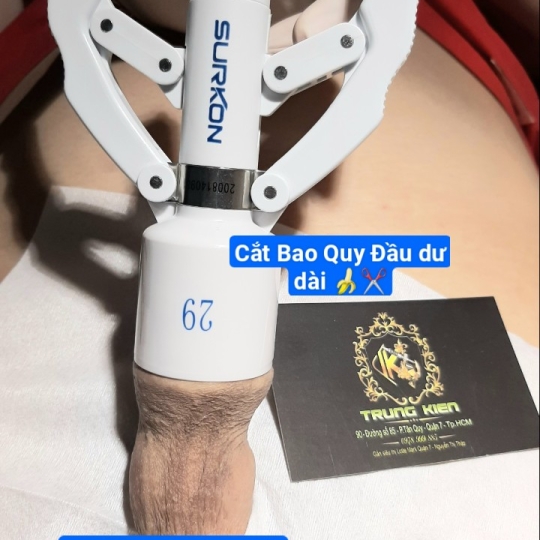 Cắt Bao Quy Đầu An Toàn bằng Máy SURKON