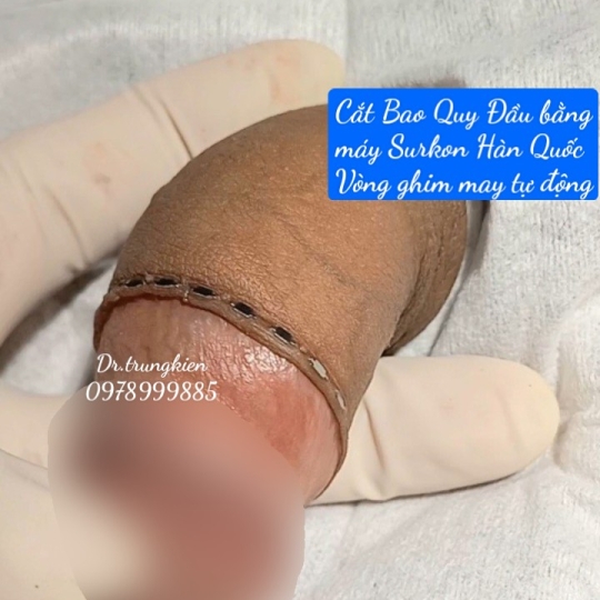 Hình Ảnh cắt Bao Quy Đầu