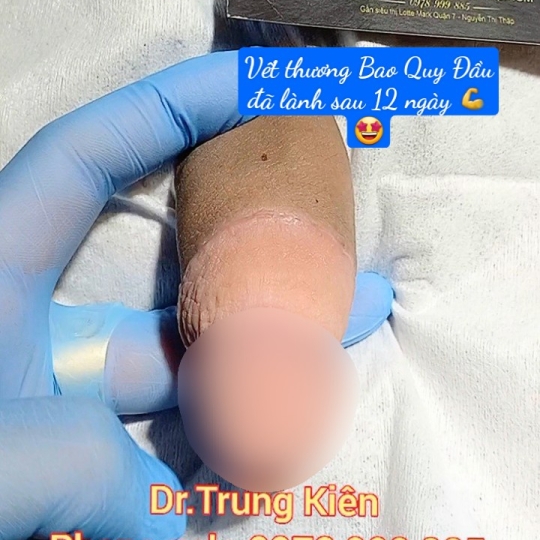 Bao Quy Đầu đã lành 