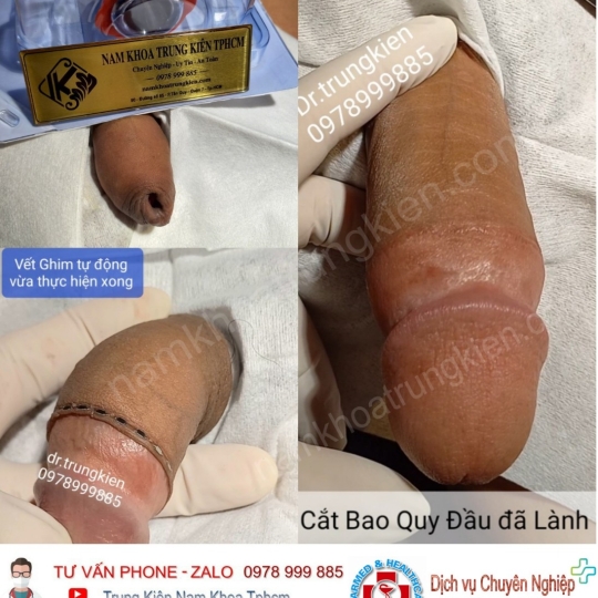 Hình ảnh cắt bao quy đầu cho Nam giới 