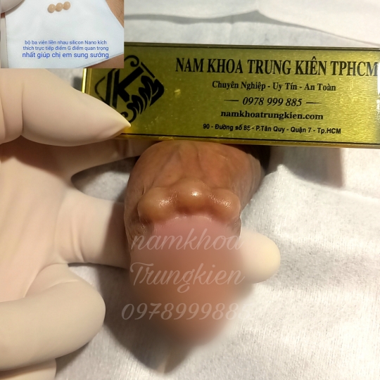 Cấy Bi Sài Gòn Bộ Bi 3v Điểm G 