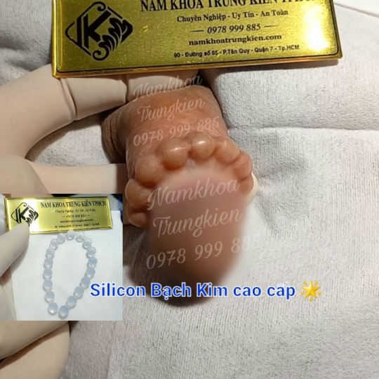 Cấy Bi Vòng Bi SILICON BẠCH KIM an toàn tại Tphcm 