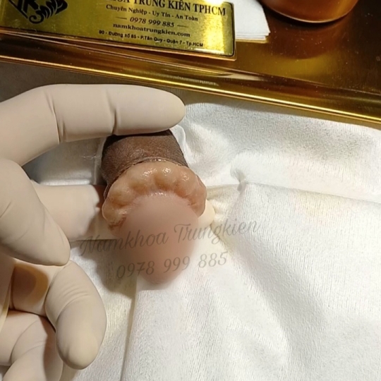 Cấy Bi giúp Đôn To cậu nhỏ hiệu quả - Cấy Bi an toàn Hcm