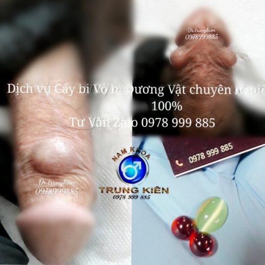 Cấy Bi giúp Đôn To cậu nhỏ hiệu quả - Cấy Bi an toàn Hcm