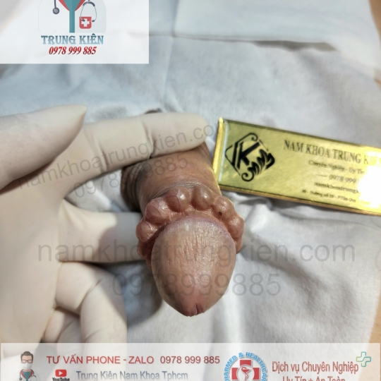 Hình ảnh cắt bao quy đầu cho Nam giới 