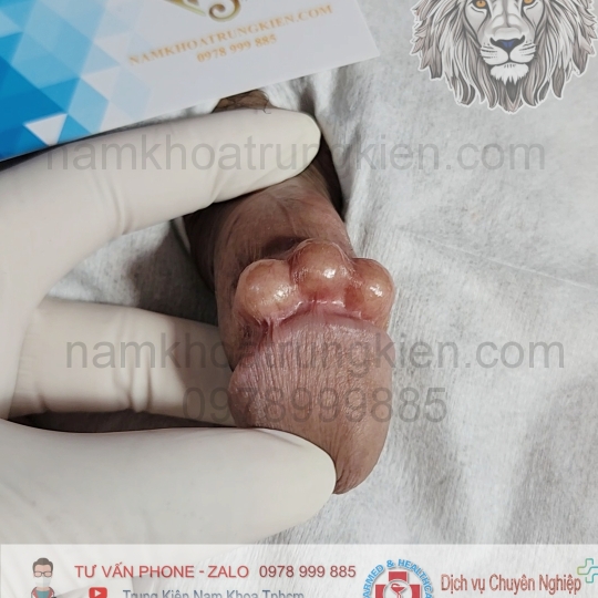 Hình ảnh cắt bao quy đầu cho Nam giới 