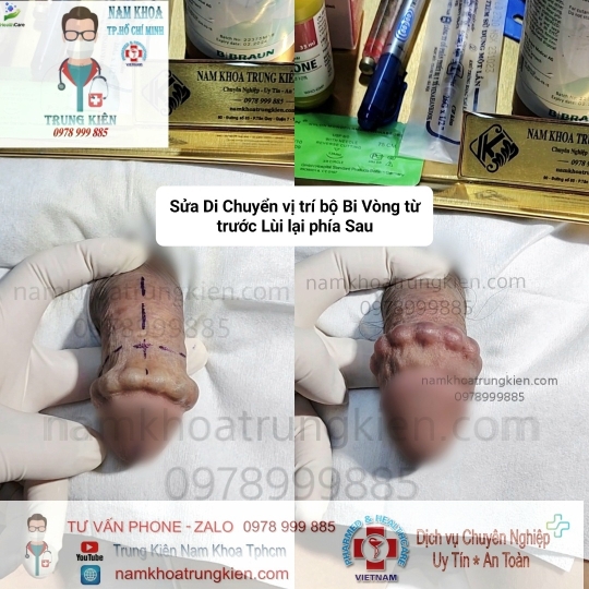 Cấy Bi giúp Đôn To cậu nhỏ hiệu quả - Cấy Bi an toàn Hcm