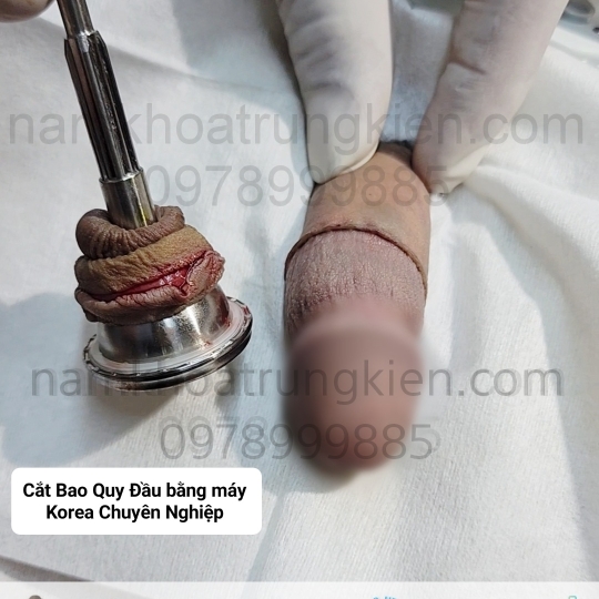 Hình ảnh cắt bao quy đầu an toàn 100% ko Đau