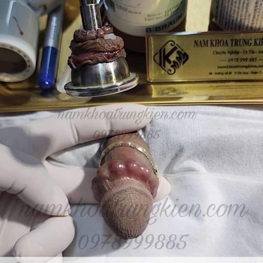 Hình ảnh cắt bao quy đầu cho Nam giới 