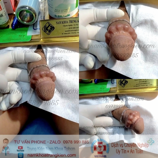 Hình ảnh cắt bao quy đầu cho Nam giới 