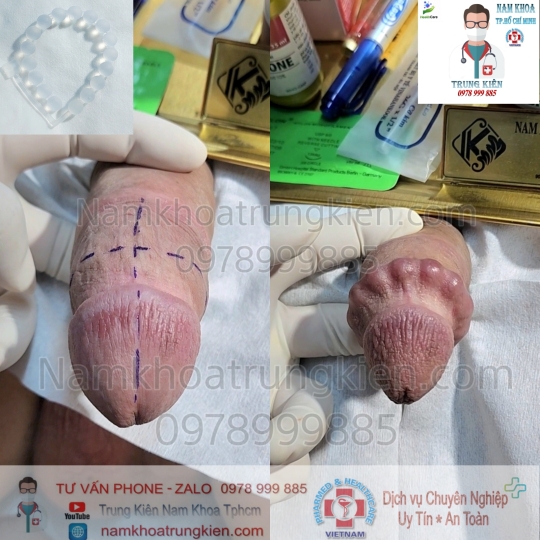 Hình ảnh cắt bao quy đầu cho Nam giới 