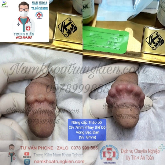 Hình ảnh cắt bao quy đầu cho Nam giới 